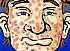 Acne Be Gone